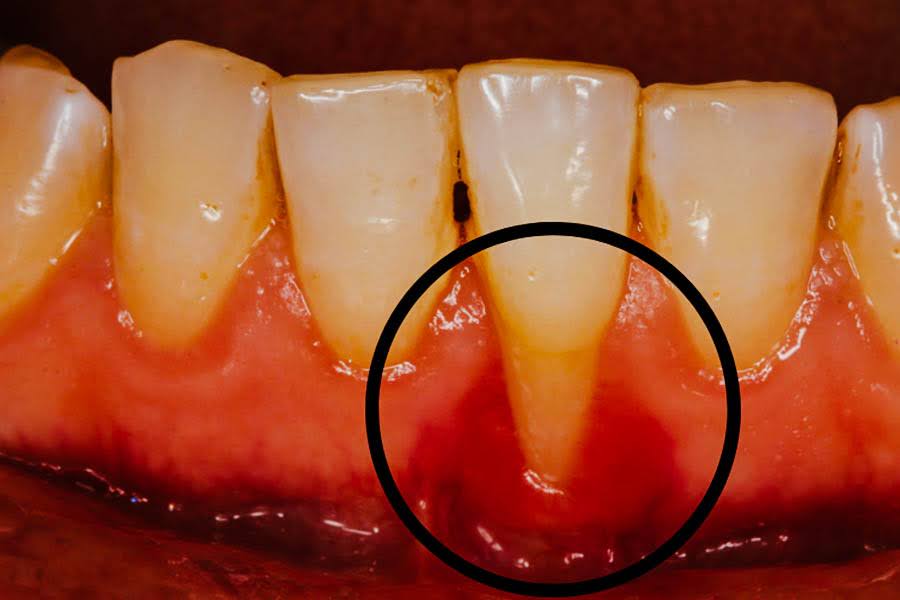 Gum Recession