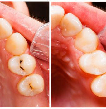 Composite Fillings