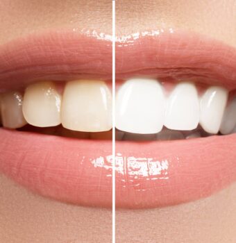 Teeth Whitening