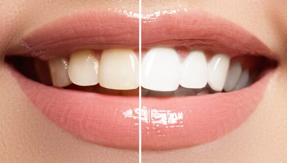 Teeth Whitening